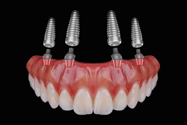 Tired Of Dentures? Try All On   Dental Implants