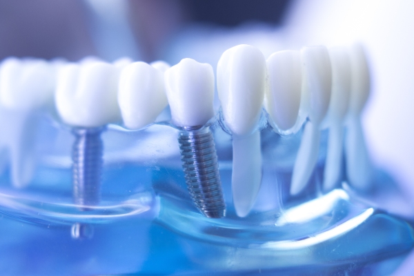 The Benefits Of Choosing A Periodontist For Your Dental Implant Needs