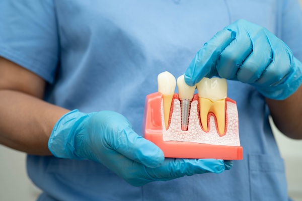 The Bone Grafting Procedure Explained By A Periodontist