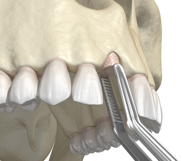 Alpharetta Bone Grafting for Dental Implants