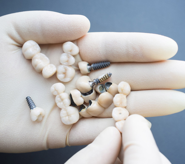 Alpharetta Crowns vs. Implants