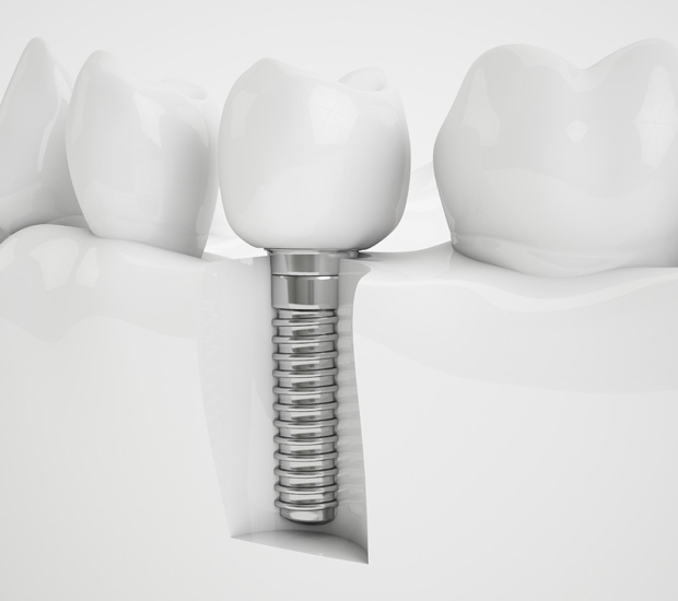 Alpharetta Dental Implants
