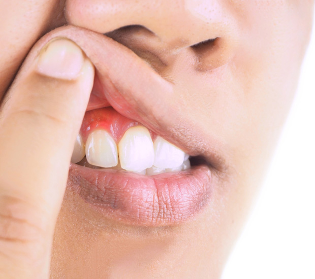 Alpharetta Gingivitis