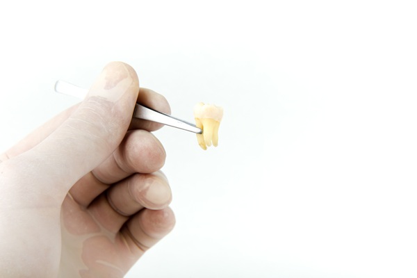 Tooth Extractions: What Happens Next?